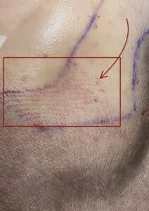 Närbild på hårfäste med uppritad hårfästsdesign och nyligen öppnade implantationskanaler vid FUE Sapphire-behandling