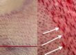 Jämförelse mellan vilande hårbotten och nyöppnade implantationskanaler med markerad riktning vid FUE Sapphire
