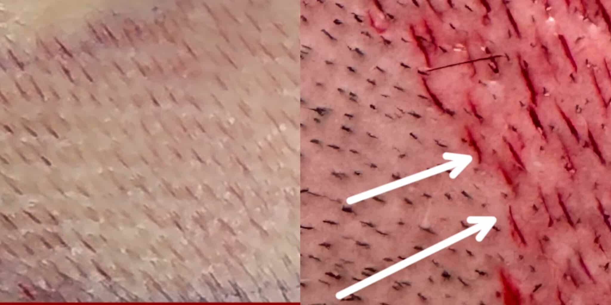 Skillnaden mellan implantationskanaler vid klassisk FUE och FUE Sapphire Jämförelse mellan vilande hårbotten och nyöppnade implantationskanaler med markerad riktning vid FUE Sapphire