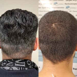 Alvaros resultat bakifrån före och cirka 2,5 år efter hårtransplantationen hos 85 Kliniken i Göteborg. Efterbilden visar även att håret har blivit gråare sedan operationen.