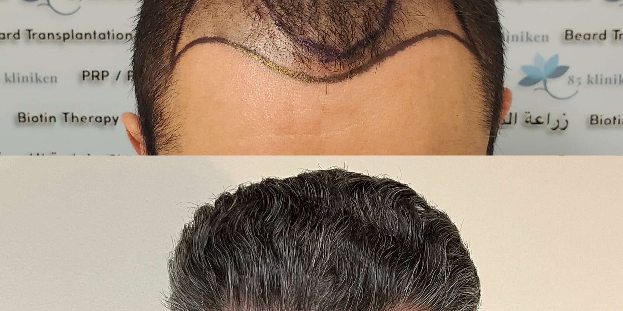 Alvaros resultat framifrån Alvaros resultat framifrån före och cirka 2,5 år efter hårtransplantationen hos 85 Kliniken i Göteborg. Efterbilden visar även att håret har blivit gråare sedan operationen.
