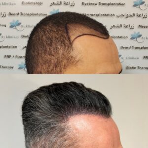 Alvaros resultat i profil före och cirka 2,5 år efter hårtransplantationen hos 85 Kliniken i Göteborg. Efterbilden visar även att håret har blivit gråare sedan operationen.
