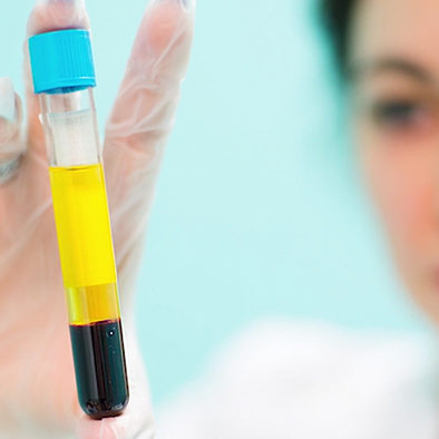 85 kliniken prp behandling sverige